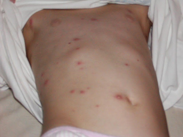Chickenpox: Symptoms, treatment, stages, and causes